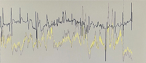 丁二烯裝置萃取精餾控制DCS畫面 丁二烯裝置萃取精餾控制DCS畫面